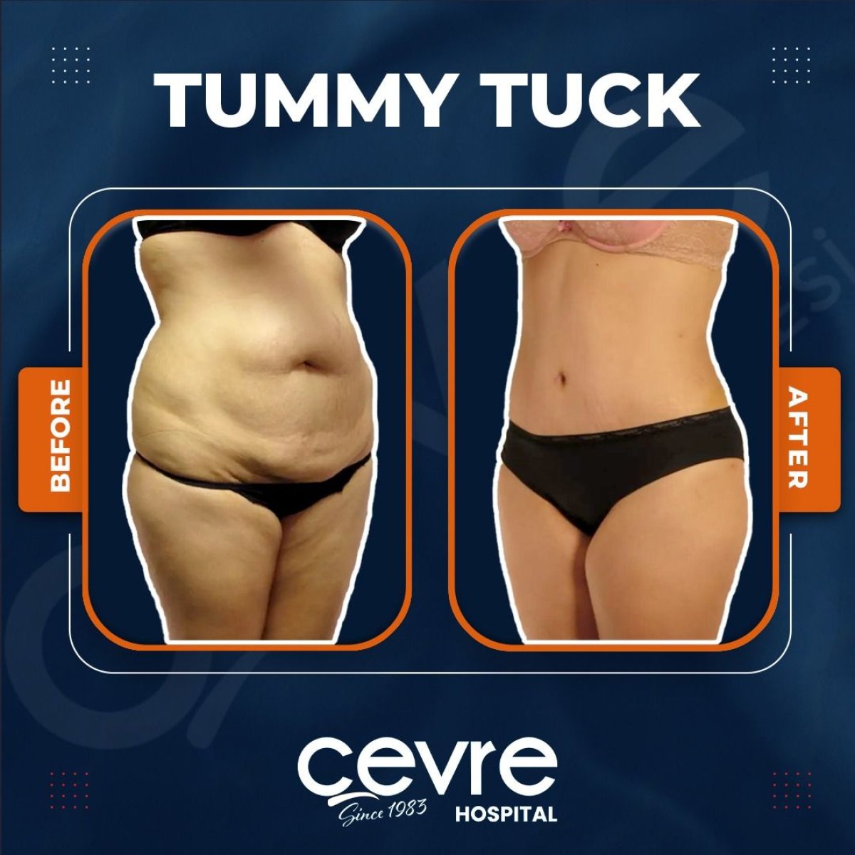 Resultados de abdominoplastia antes y después en Cevre Hospital – mejora del contorno abdominal