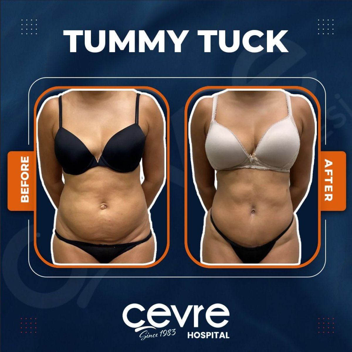 Resultados antes y después de mommy makeover en Adem and Havva Medical Center, abdomen plano