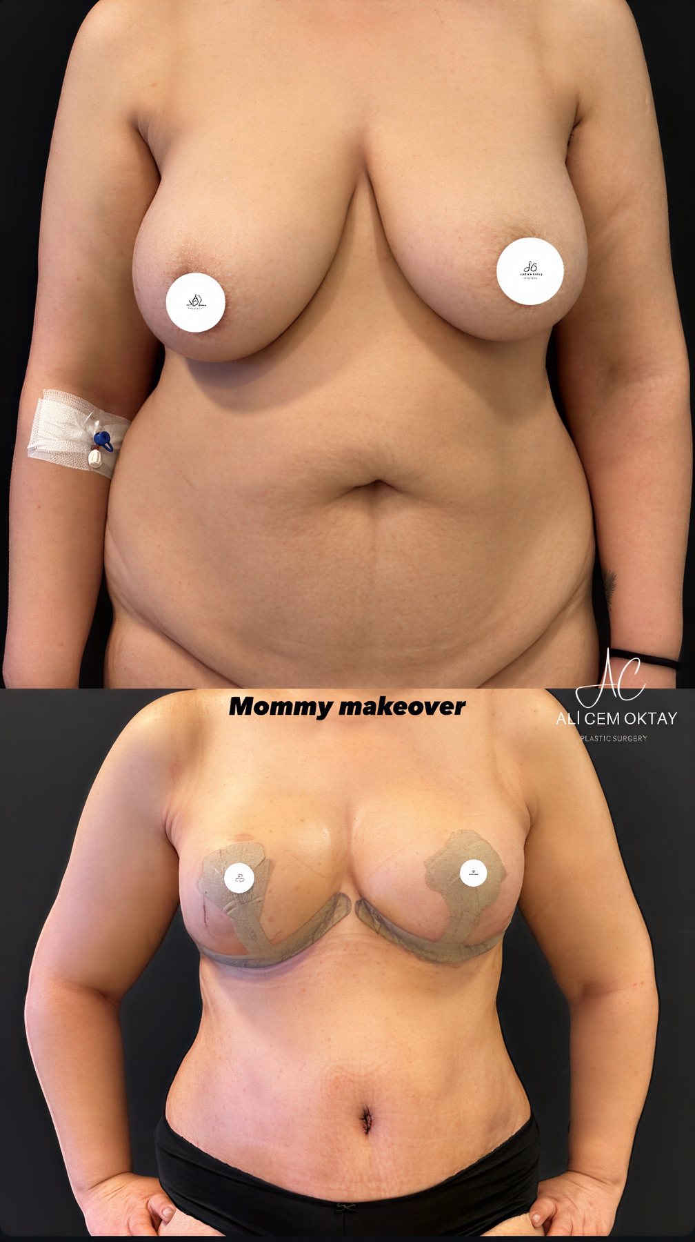 Resultados antes y después de mommy makeover en Adem and Havva Medical Center, mejor contorno corporal