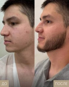 Beard Hair Transplantation
