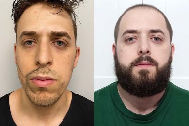 Beard Hair Transplantation - photo 2