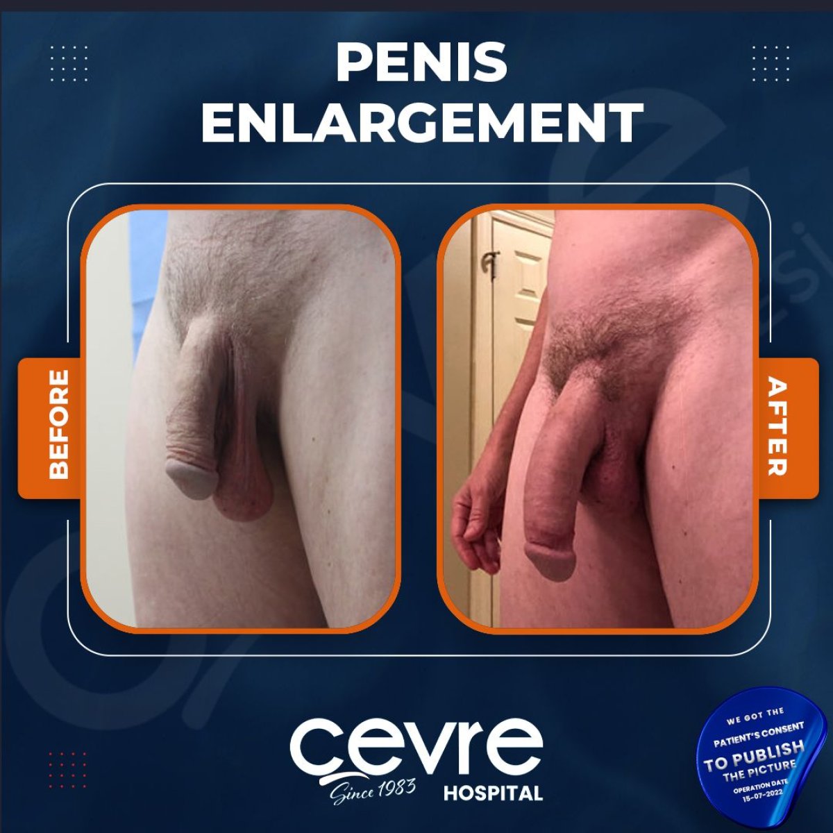 نتائج تكبير القضيب قبل وبعد في Adem and Havva Medical Center، زيادة واضحة بالحجم