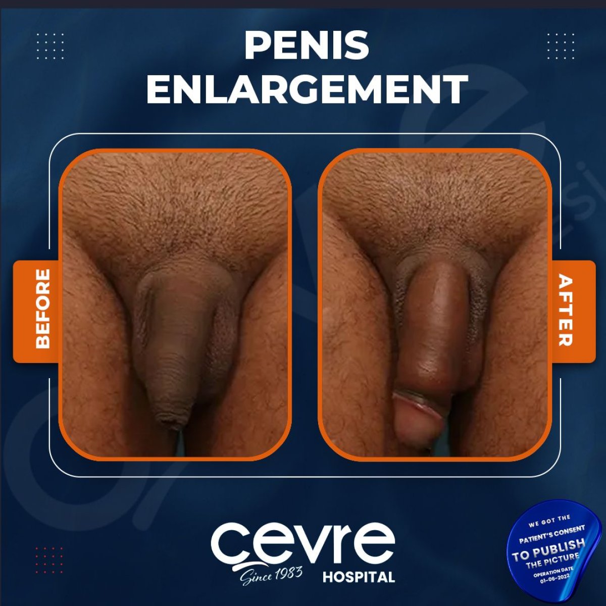 Before and after penis enlargement results at Cevre Hospital, visible size improvement