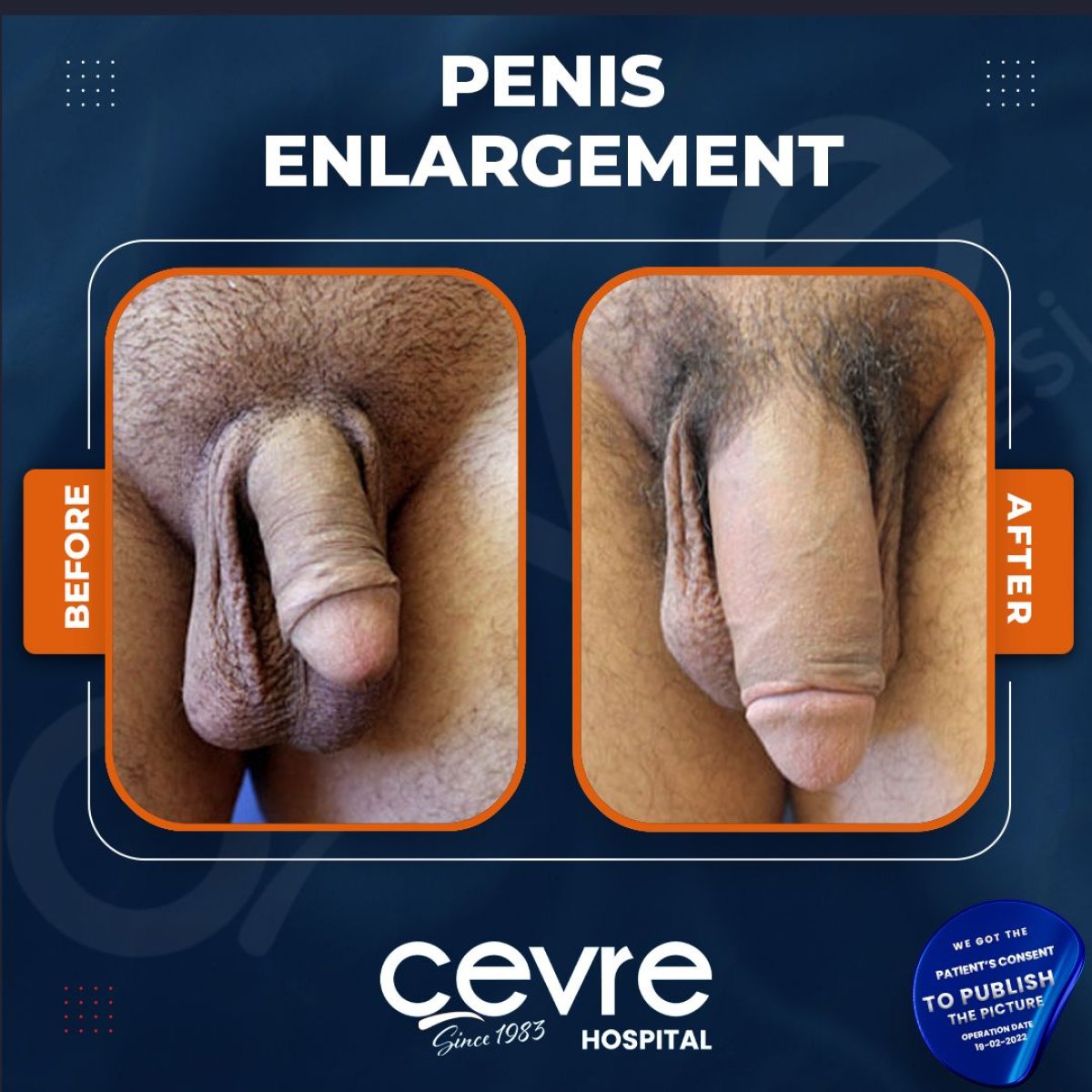 Before and after penis enlargement results at Adem and Havva Medical Center, visible size increase