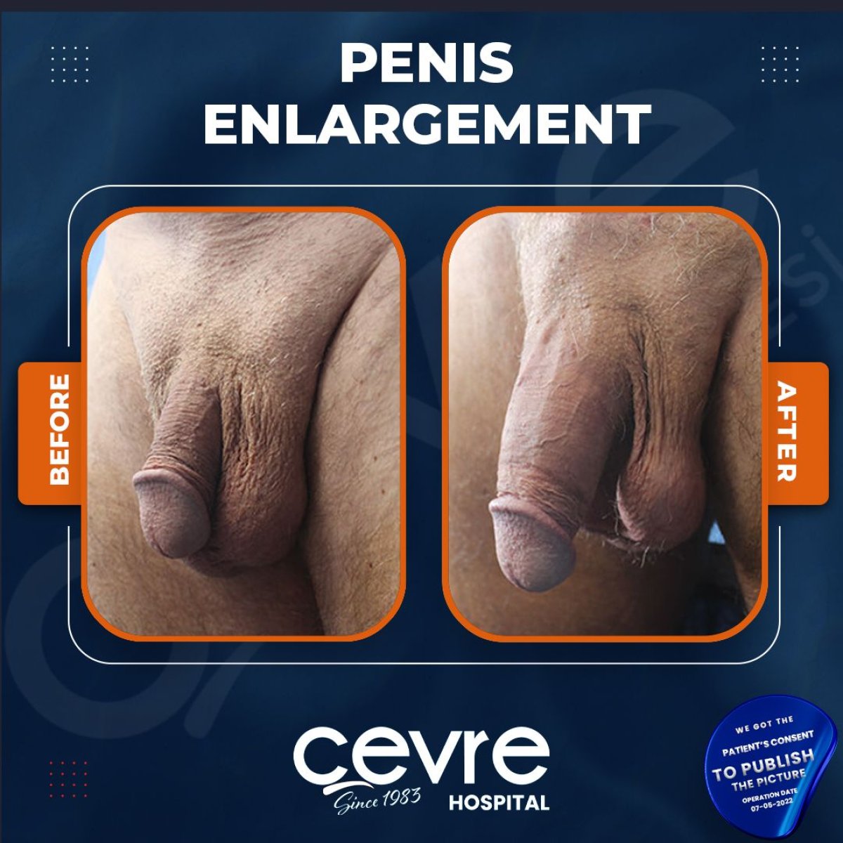 نتائج تكبير القضيب قبل وبعد في مستشفى Cevre، تحسن ملحوظ في الحجم