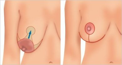 Premium Breast reduction w& Lift All Included (No Implants) - photo 3