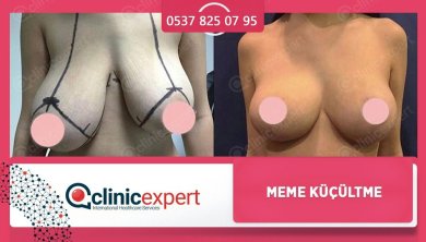 Premium Breast reduction w& Lift All Included (No Implants) - photo 2
