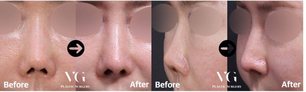 نتائج عملية تجميل الأنف قبل وبعد في VG Plastic Surgery مع مظهر طبيعي للأنف