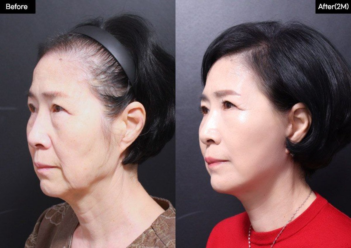 نتائج شد الوجه قبل وبعد في VG Plastic Surgery، تجديد ورفع ملحوظ للوجه