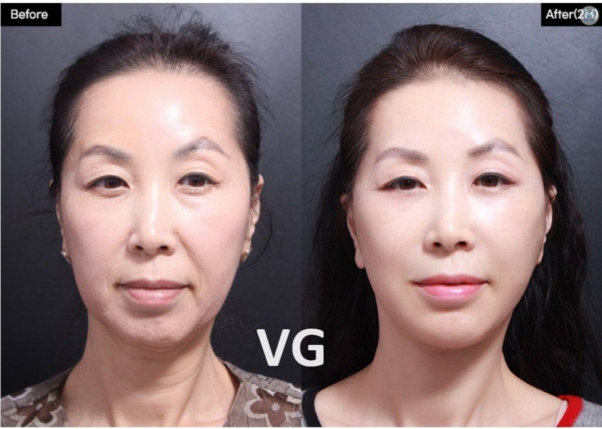 نتائج قبل وبعد رفع الشفاه في VG Plastic Surgery، تحسين وتجديد الشفاه بشكل واضح