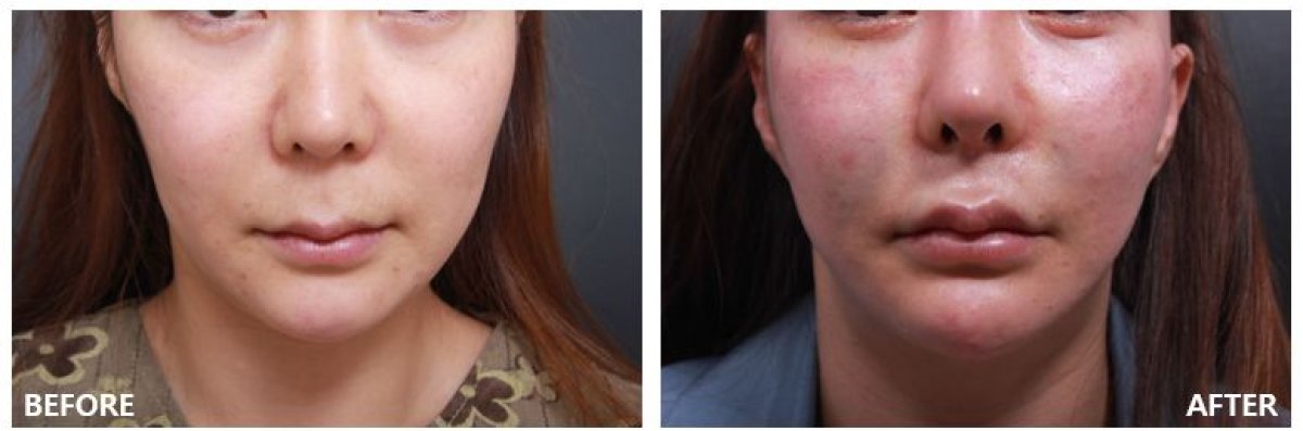 نتائج رفع الشفاه قبل وبعد في VG Plastic Surgery، تحسين شكل وحجم الشفاه