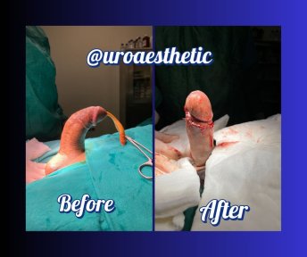 Standard Penis enlargement All Included - photo 3