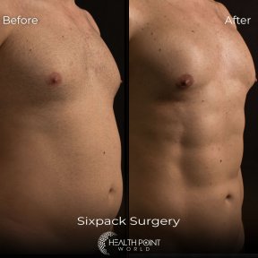 Vaser Liposuction 2-3 zones - photo 2
