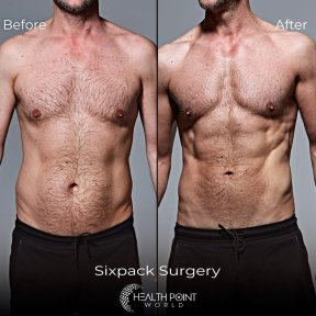 Vaser Liposuction 2-3 zones