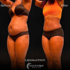 Vaser Liposuction 2-3 zones - photo 3