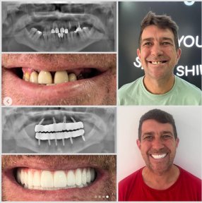 Full Mouth All-on-4 Implant Treatment - Hotel & Transfer Included (Zirconia Bridge)-Neodent Straumann Group Implants - photo 5