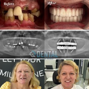 Full Mouth All-on-4 Implant Treatment - Hotel & Transfer Included (Zirconia Bridge)-Neodent Straumann Group Implants - photo 4