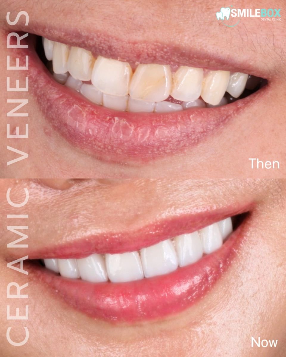 Результат до і після керамічних вініров у SmileBox Dental Clinic - Thonglor, Sukhumvit