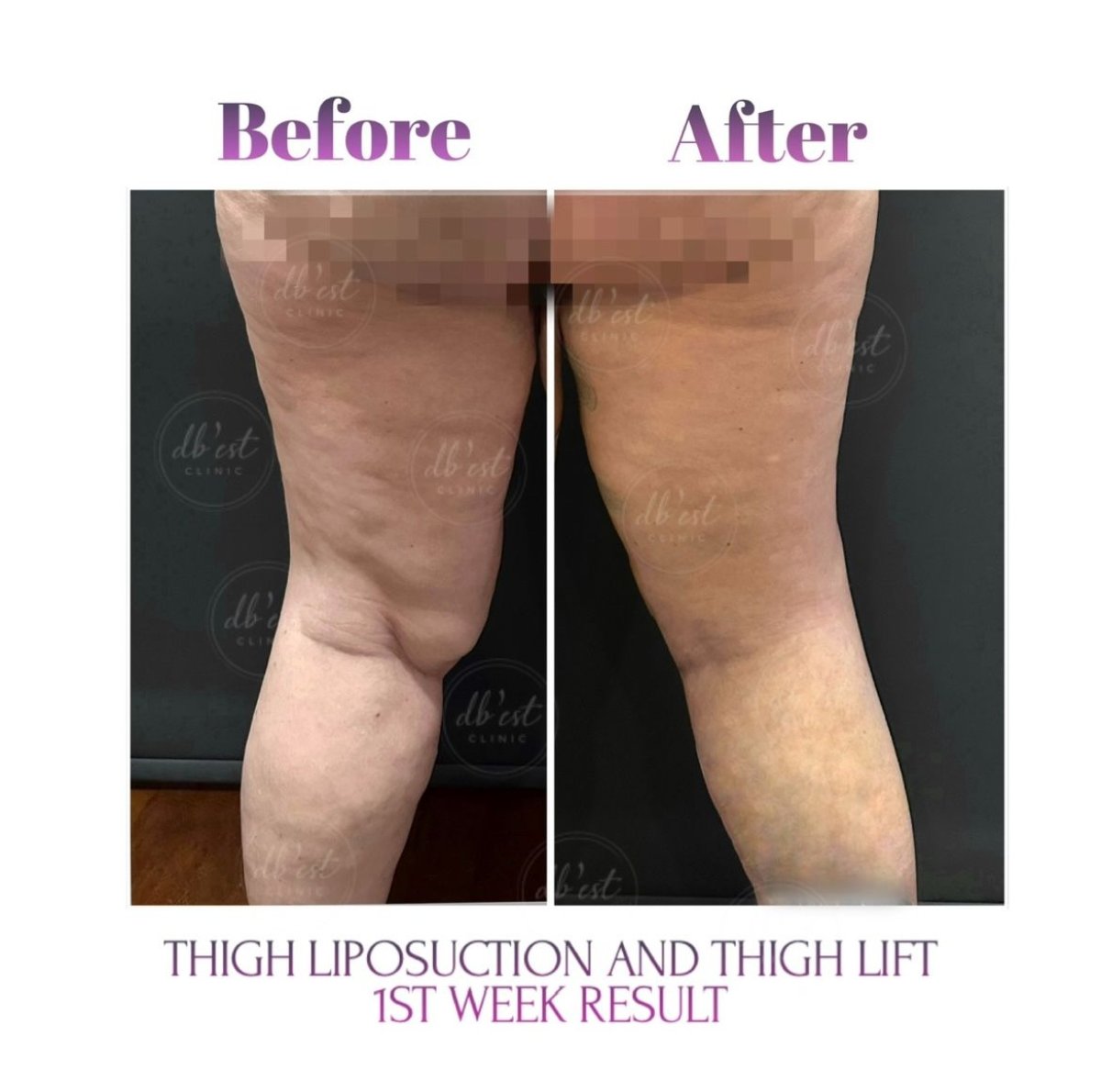 Before and after thigh lift and liposuction result at Db'est Clinic – slimmer thigh contour