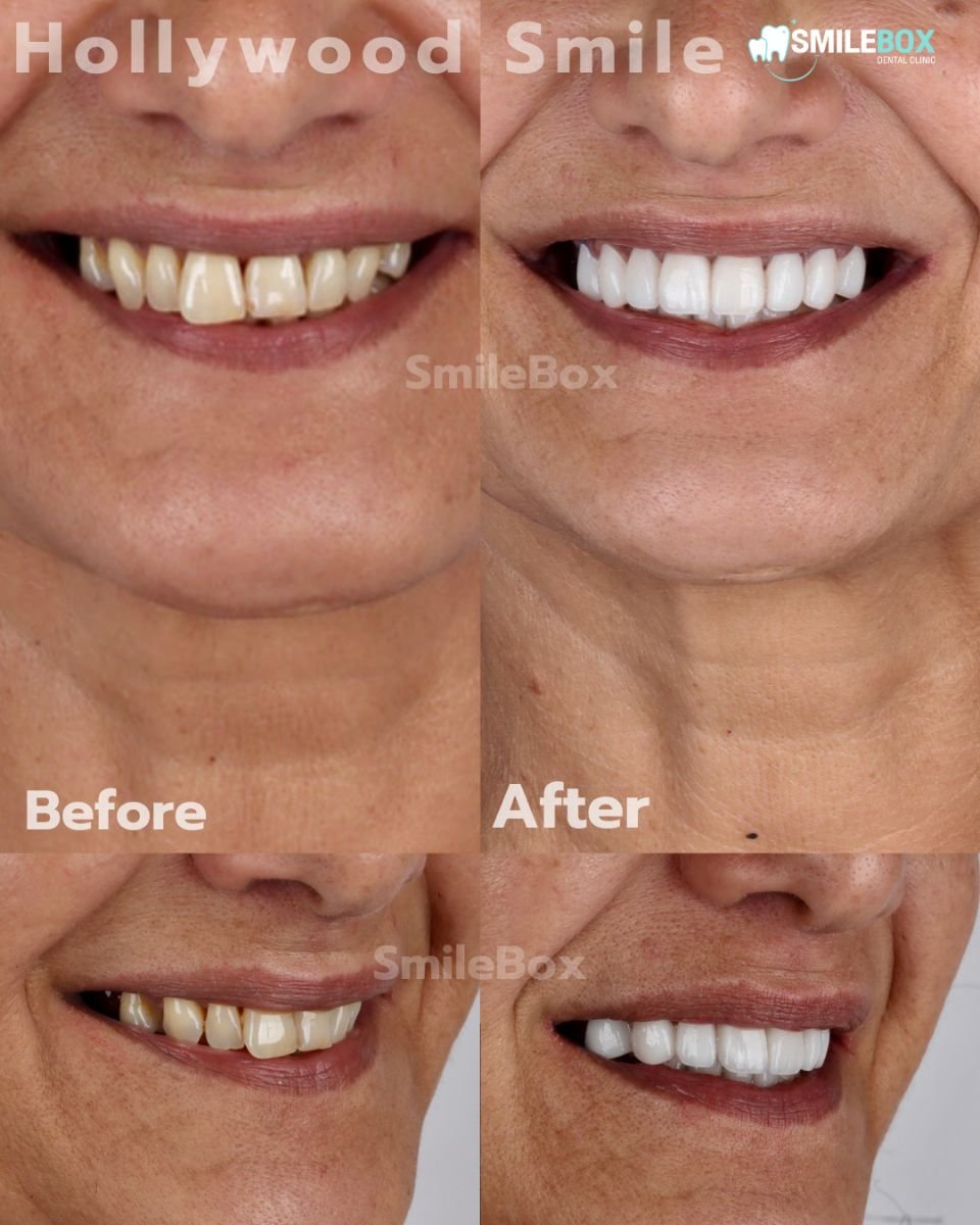 نتائج قبل وبعد الفينير في SmileBox Dental Clinic - Thonglor, Sukhumvit Branch