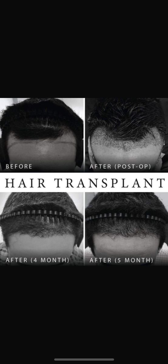 نتائج زراعة الشعر FUE قبل وبعد في Asia Cosmetic Hospital، نمو شعر ملحوظ