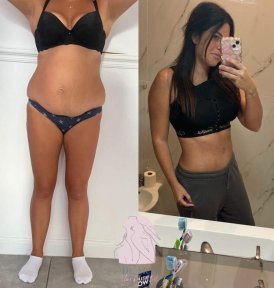 Total Body Liposuction & Liposculpture ALL INCUDED OFFER HD LIPOSCULPTURE - photo 2