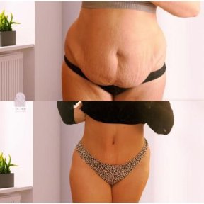 Total Body Liposuction & Liposculpture ALL INCUDED OFFER HD LIPOSCULPTURE - photo 2