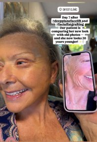 Blepharoplasty (Eyelid Correction Surgery) with European Board Certified Surgeon - photo 3