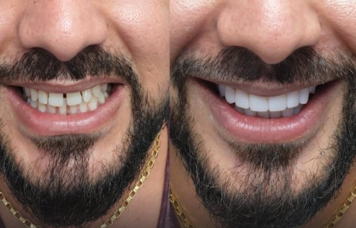 نتائج قبل وبعد ابتسامة هوليوود في About Tooth Dental Clinic – تجميل الابتسامة بالفينير
