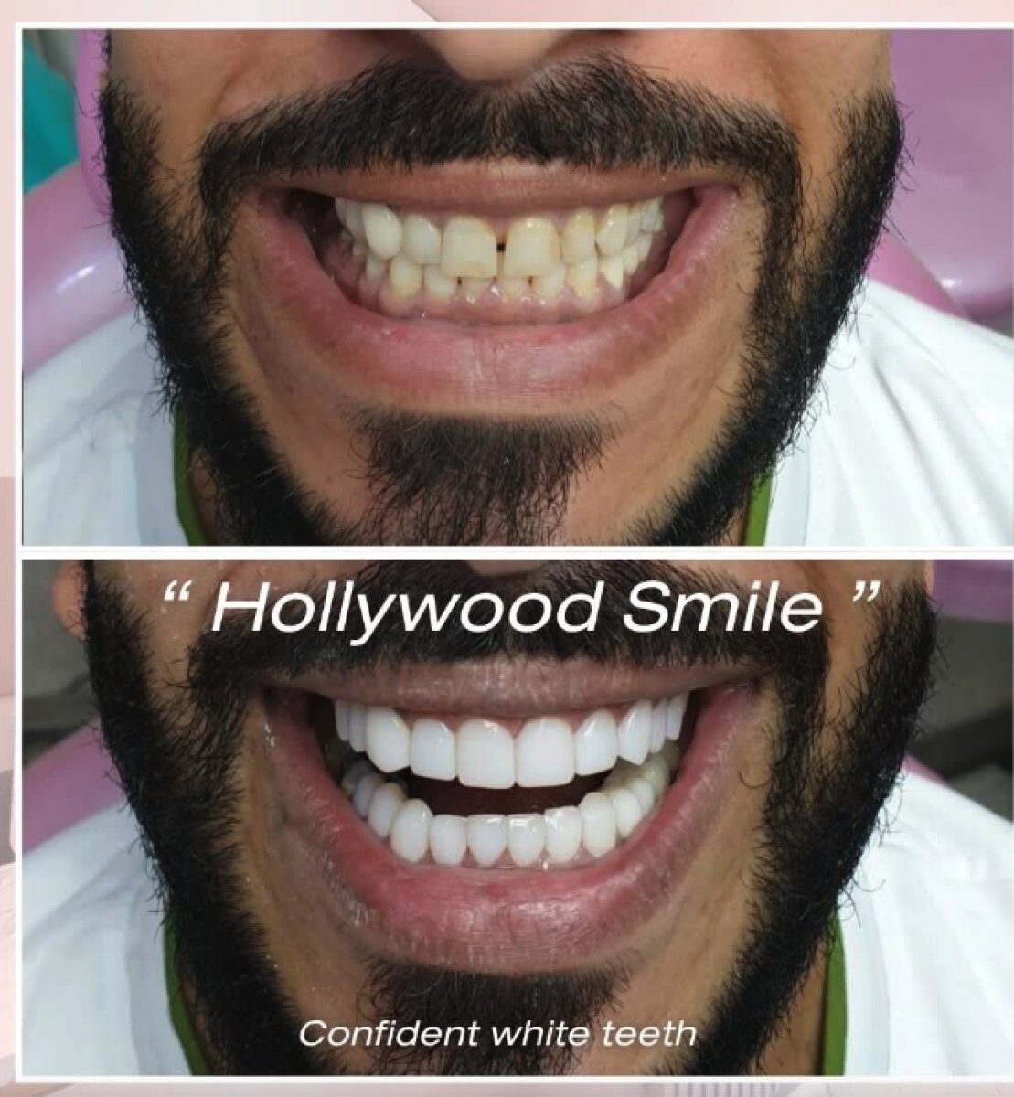 Hollywood Smile before and after results at About Tooth Dental Clinic – whiter, aligned teeth