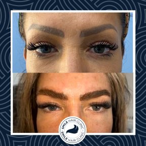 Saphire FUE Eyebrow Transplant Platinum Package - photo 6