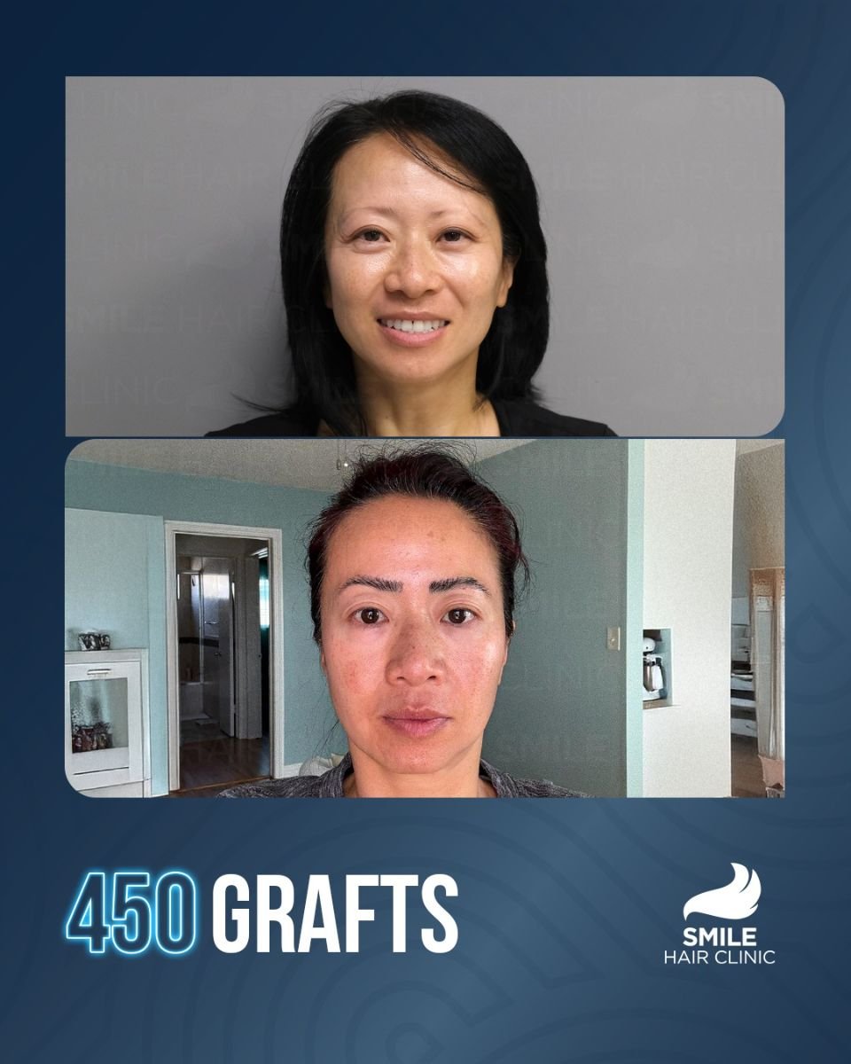 Resultado de trasplante de cejas con 450 injertos antes y después en Smile Hair Clinic Turquía