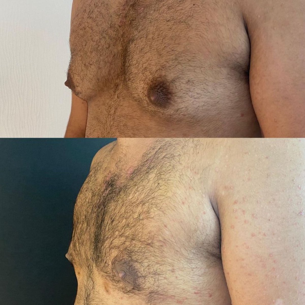Before and after gynecomastia surgery results at Lokman Hekim Istanbul Hospital, male chest contour