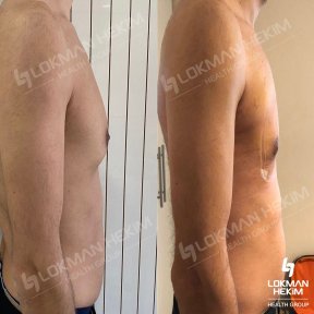 Premium Gynecomastia Surgery All- Inclusive
