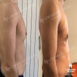 Fotos de antes y después de Cirugía de ginecomastia tomadas por el Dr.(la Dra.) Murat Yaman