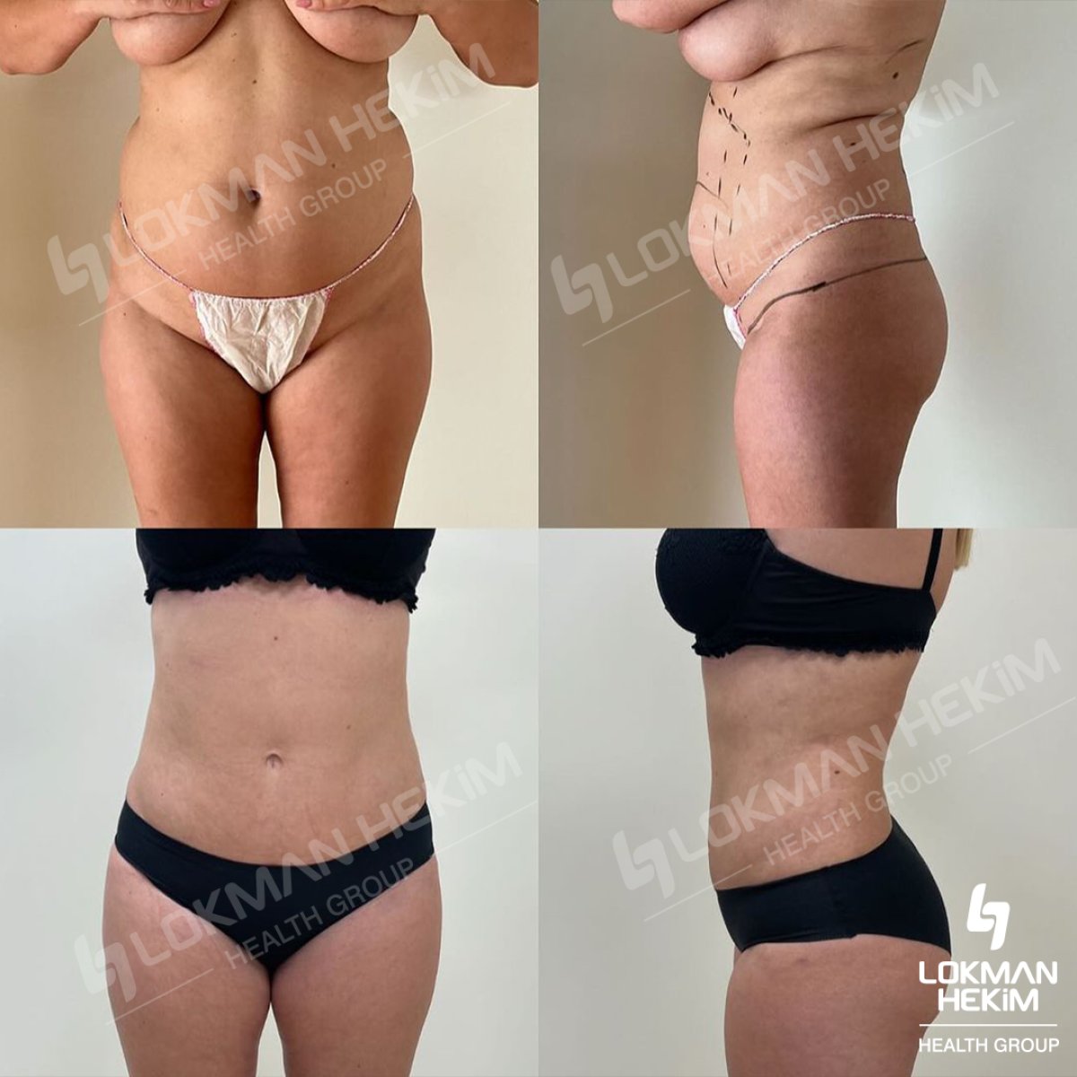Resultados de liposucción antes y después en Lokman Hekim Istanbul Hospital, mejor contorno corporal
