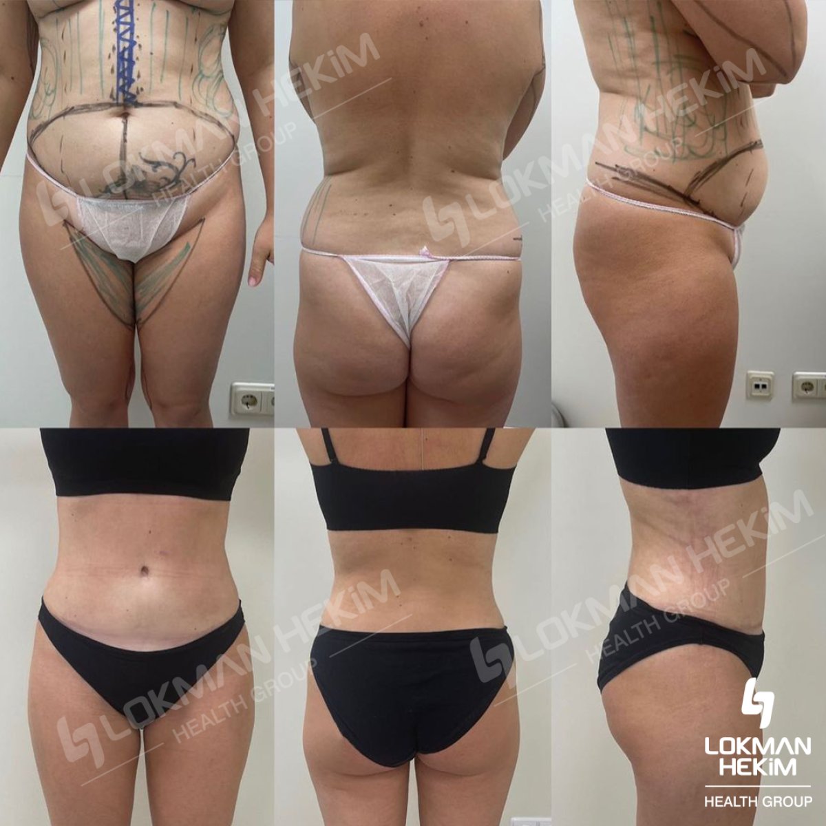 Efekty liposukcji przed i po w Lokman Hekim Istanbul Hospital, poprawiony kontur ciała