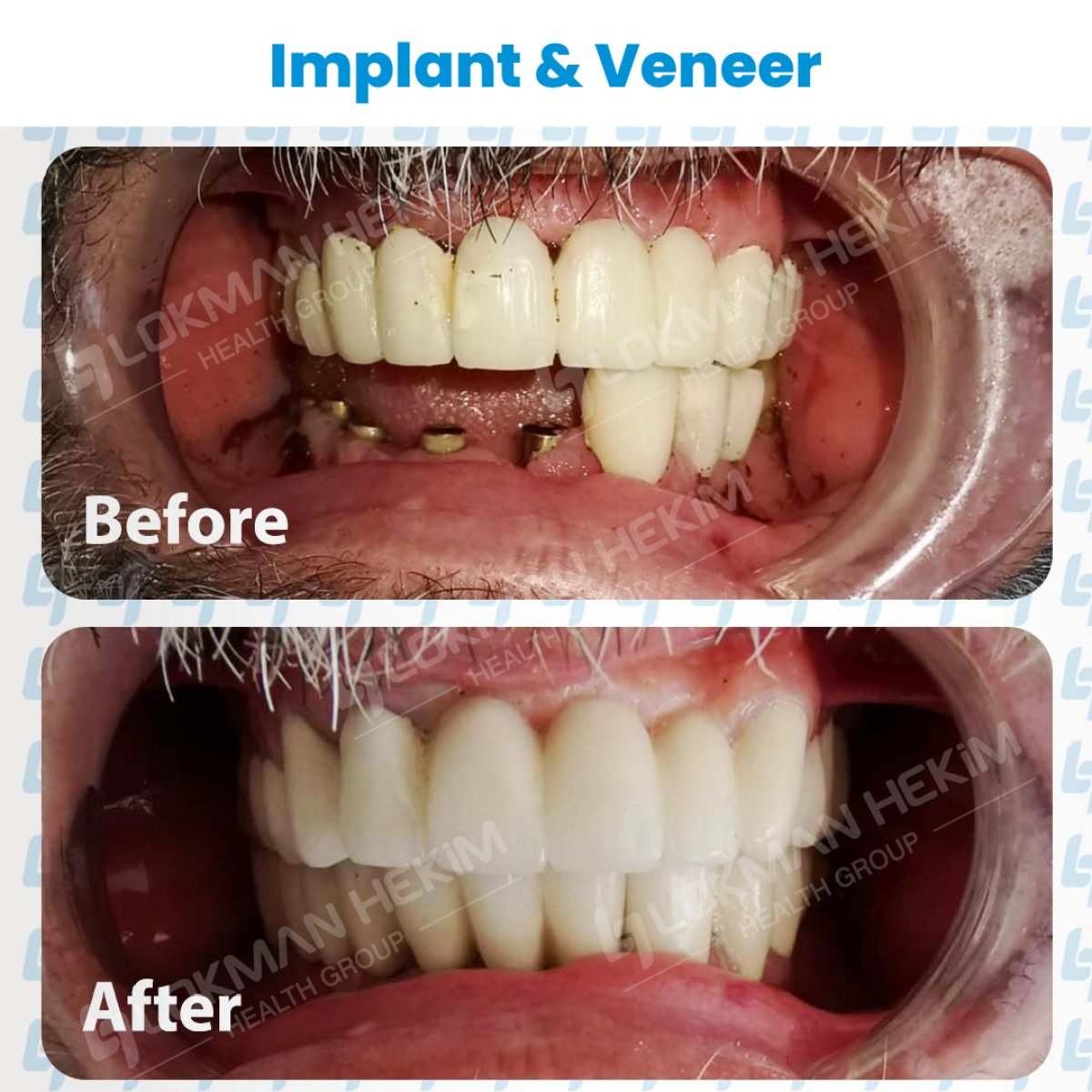 Résultats avant/après implants dentaires et facettes à Lokman Hekim Istanbul