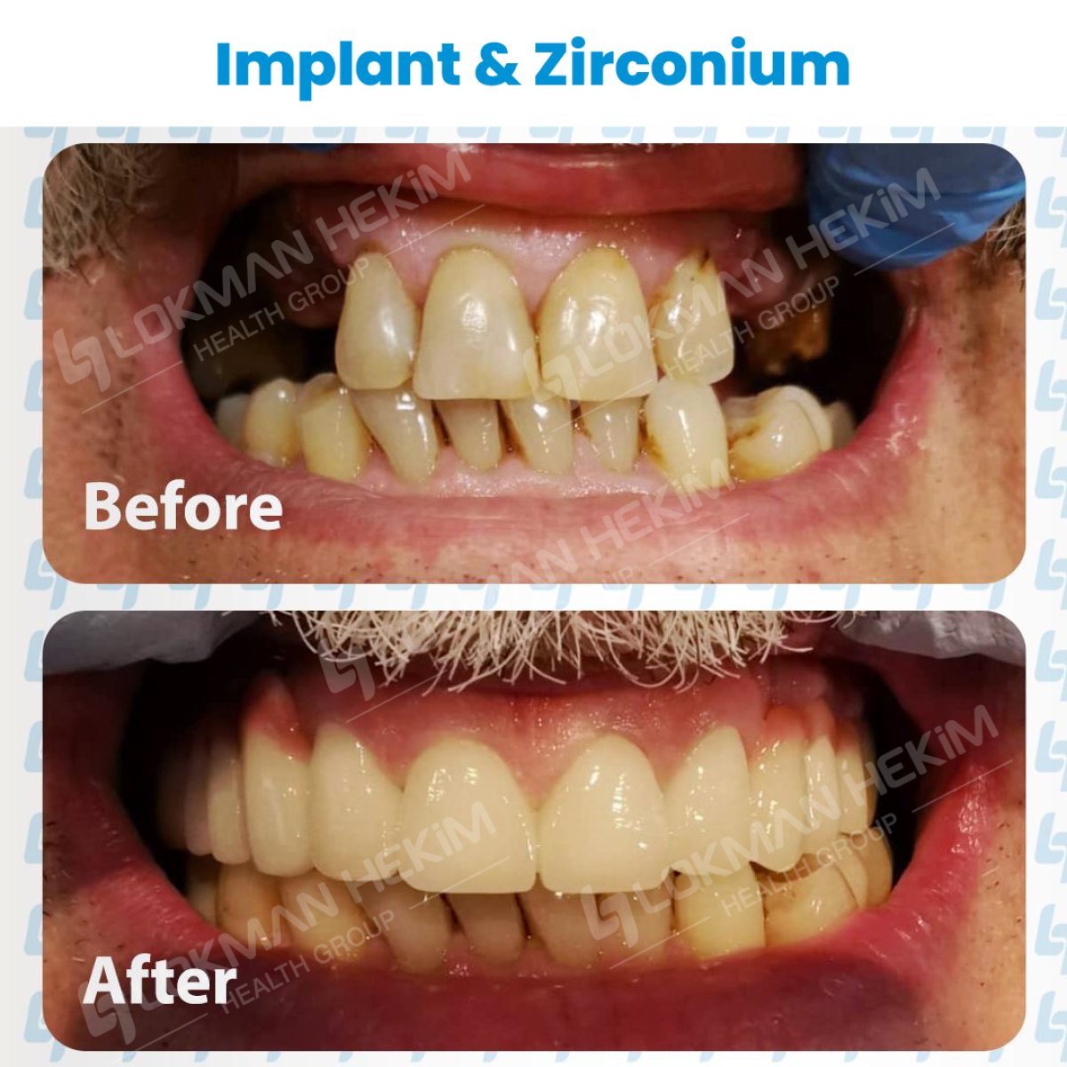 Resultados antes y después de implantes dentales y coronas de zirconio en Lokman Hekim Estambul