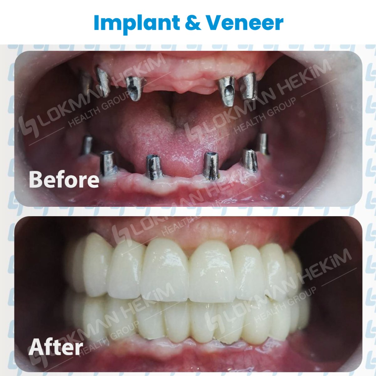 Résultats avant/après implants dentaires et facettes à Lokman Hekim Istanbul