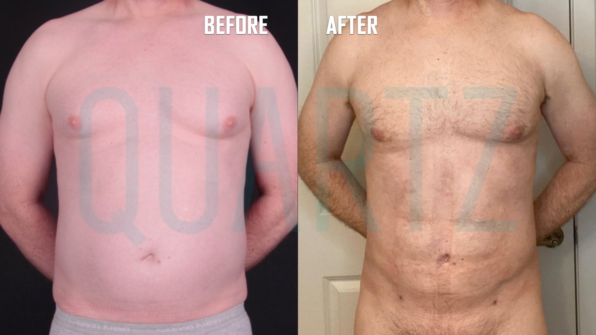 Before and after abdominal etching results at Quartz Hospital – defined six pack abs