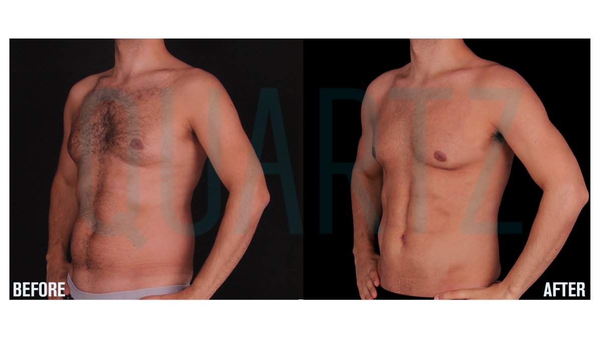 Before and after abdominal etching results at Quartz Hospital – defined six pack abs