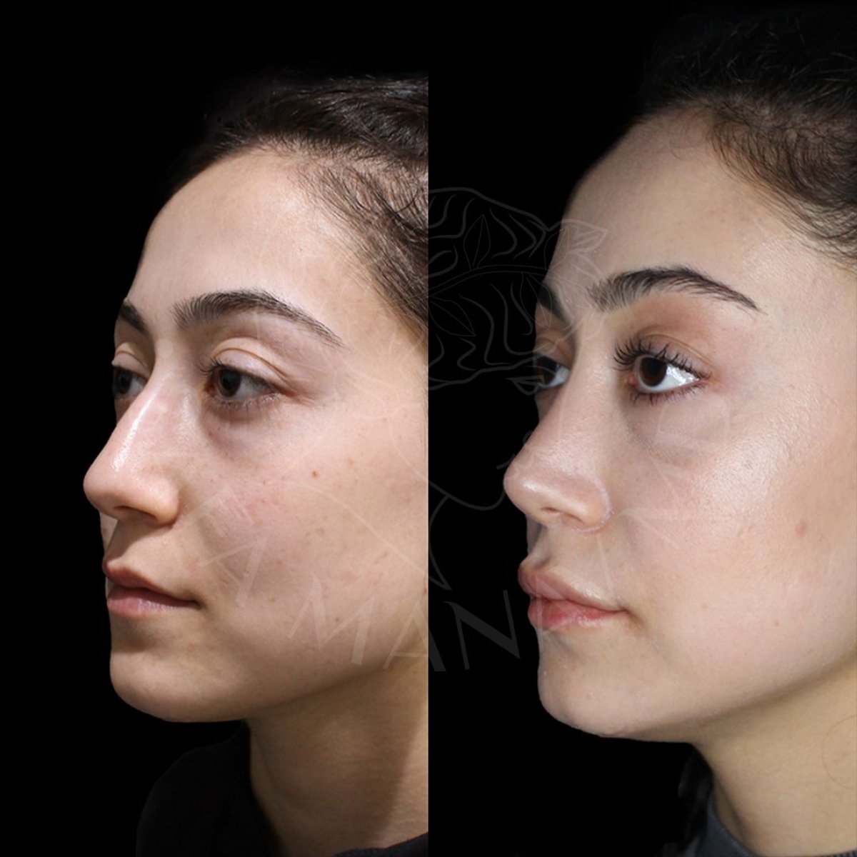 نتائج تجميل الأنف قبل وبعد في عيادة Dr. Safa Manav، إعادة تشكيل الأنف بمظهر طبيعي