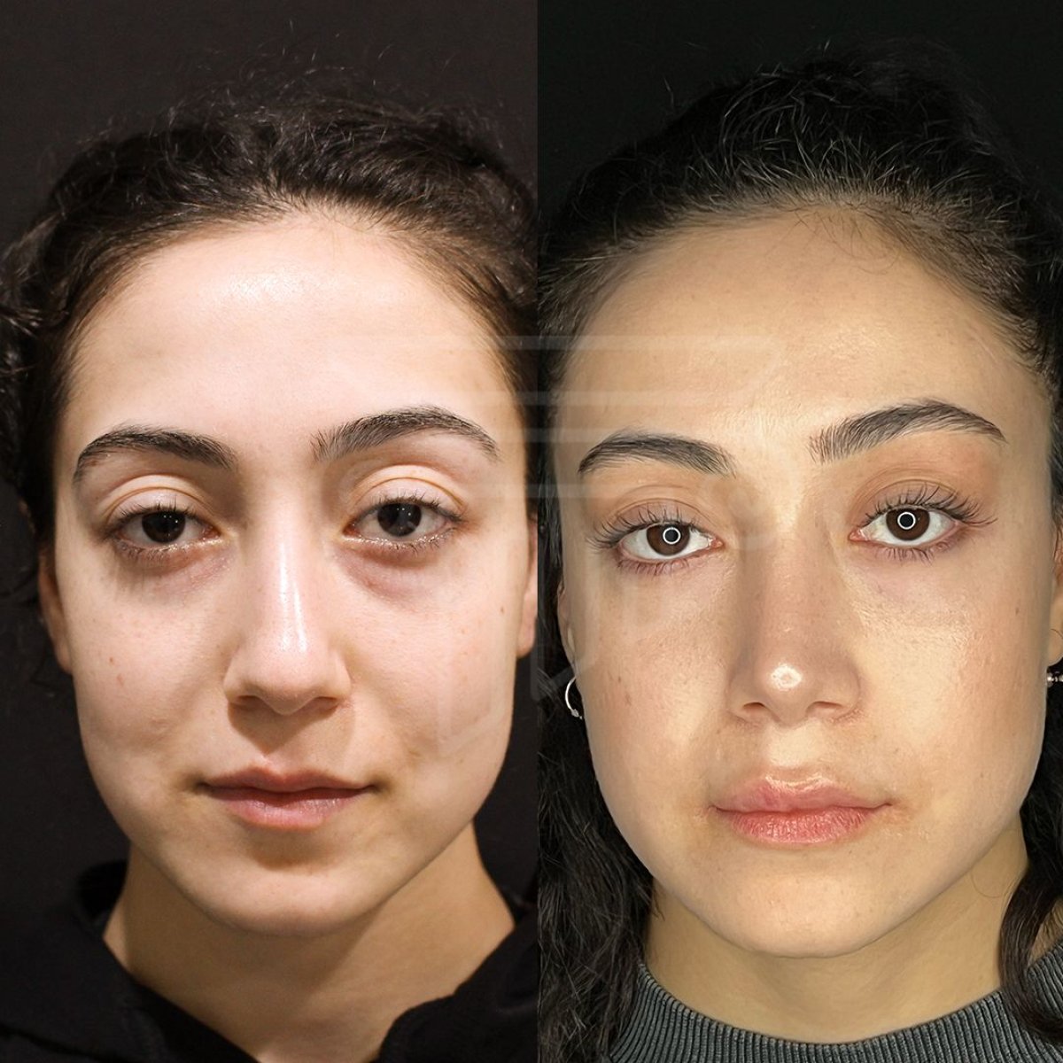 نتائج عملية تجميل الأنف قبل وبعد في عيادة Dr. Safa Manav، إعادة تشكيل الأنف بشكل طبيعي