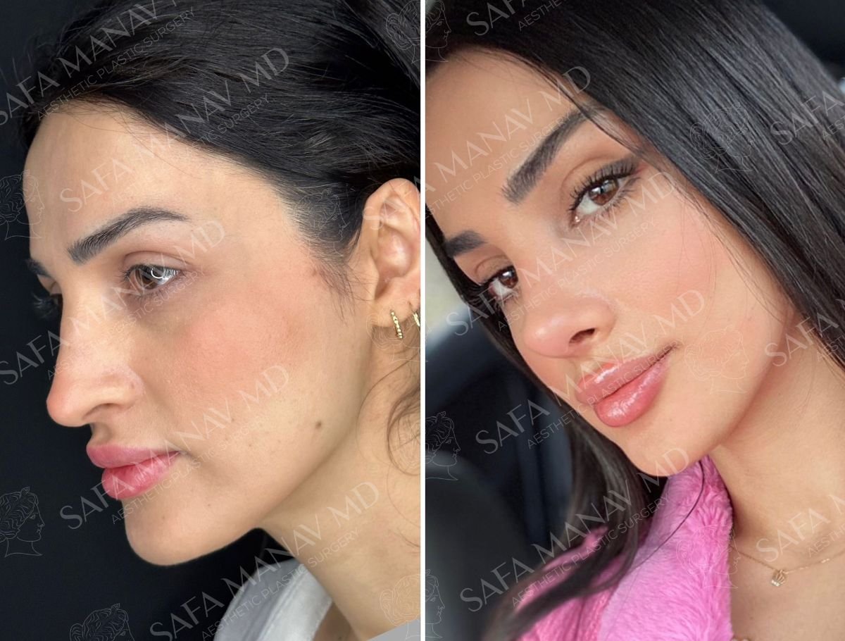 نتائج عملية تجميل الأنف قبل وبعد في عيادة Dr. Safa Manav، إعادة تشكيل الأنف بمظهر طبيعي