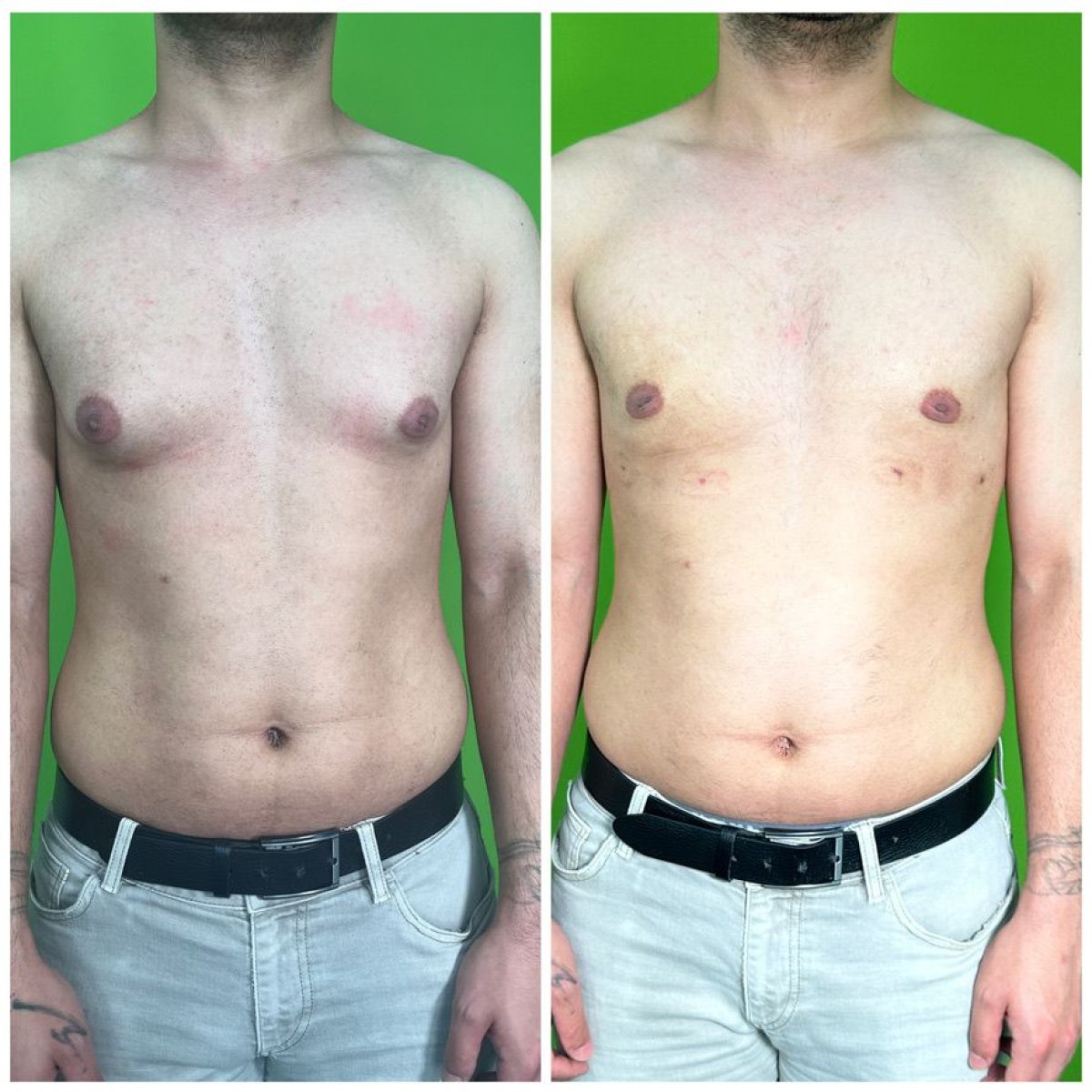 Before and after gynecomastia surgery results at Prof. Furkan Karabekmez's Aesthetic Clinic