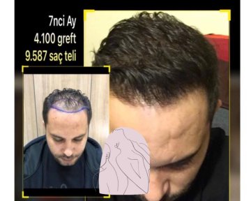 FUE hair transplant All Included - photo 5