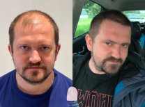 صور قبل وبعد زراعة الشعر للدكتور Hakan Ikizoglu