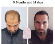 صور قبل وبعد زراعة الشعر للدكتور Hakan Ikizoglu