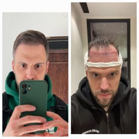 FUE hair transplant All Included